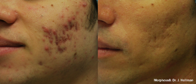 Microneedling Morpheus 8 Image