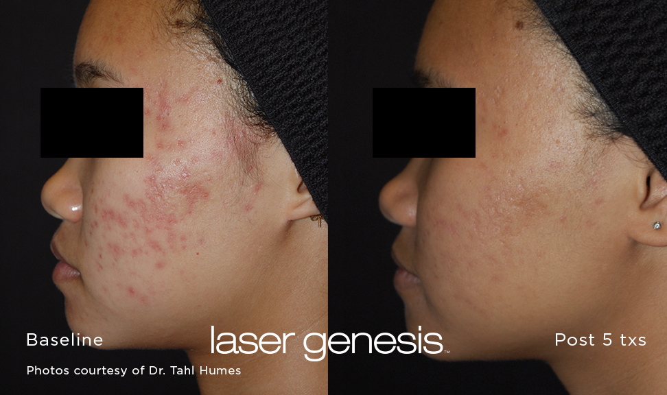 Acne Scars and other Scar Reduction Image