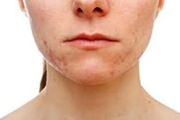 Acne Scars and other Scar Reduction