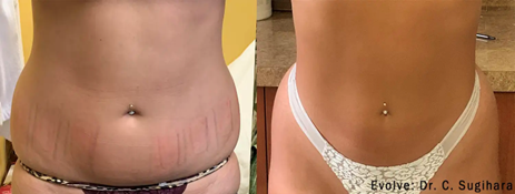 Body Sculpting with Evolve Radiofrequency