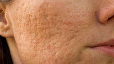 Acne Scars and other Scar Reduction