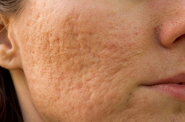 Acne Scars and other Scar Reduction